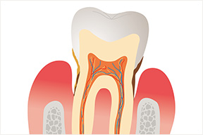 歯周病とは